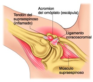 Tendón supraespinoso inflamado en el hombro